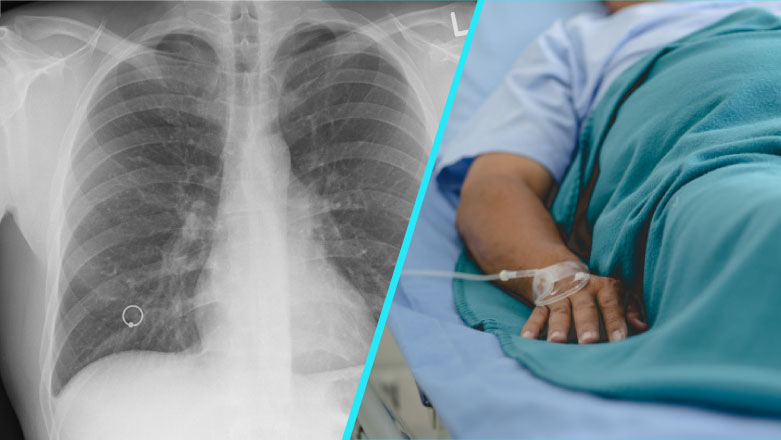 Scaderea numarului de cazuri diagnosticate de tuberculoza, din cauza fricii pacientilor de a se prezenta la medic
