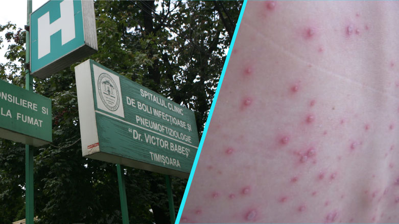 Explozie a cazurilor de varicela la Spitalul Victor Babes Timisoara: Cate 3-4 pacienti pe zi