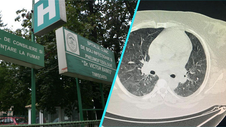 Spitalul Victor Babes Timisoara: Crestere accentuata a cazurilor de pneumonie comunitara