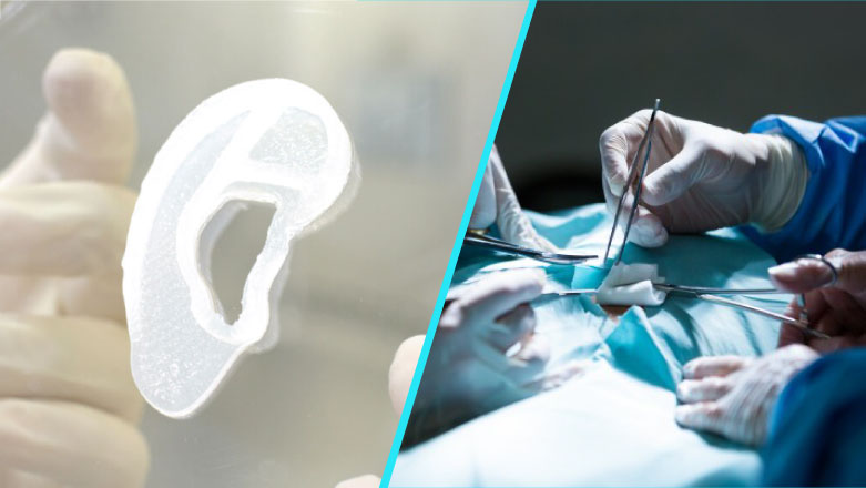 Premiera mondiala: Implant de ureche imprimat 3D cu celule umane