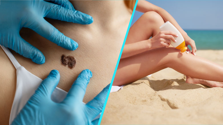 DSP Neamt atrage atentia asupra cresterii cazurilor de melanom
