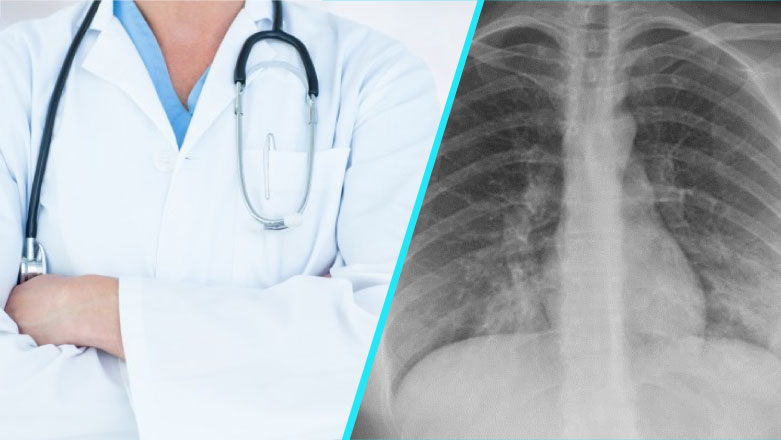 Pneumonia interstitiala atipica | De multe ori, diagnosticul etiologic este dificil de realizat