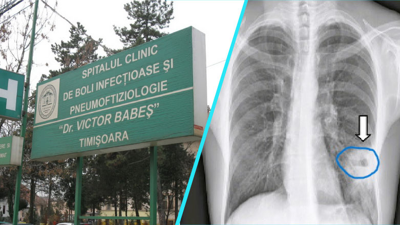 Spitalul Victor Babes Timisoara | Abcesul pulmonar: Cauze, simptome si tratament