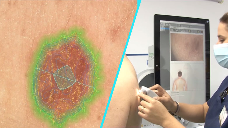 Inteligenta artificiala pentru depistarea precoce a cancerului de piele, la Timisoara