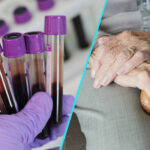 Studiu: Test de sange pentru diagnosticarea bolii Parkinson