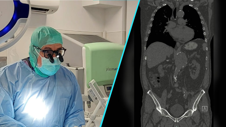 Premiera intr-un spital public din Capitala: Caz complex de anevrism de aorta toracoabdominal