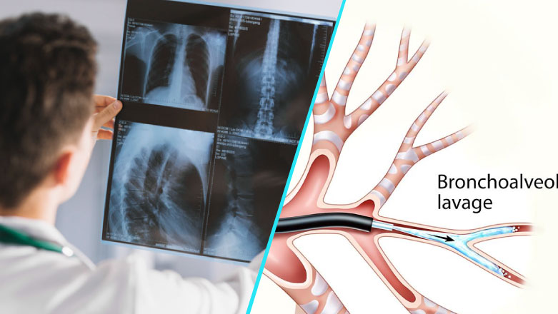 Lavajul bronhoalveolar – metoda de diagnostic in patologia respiratorie