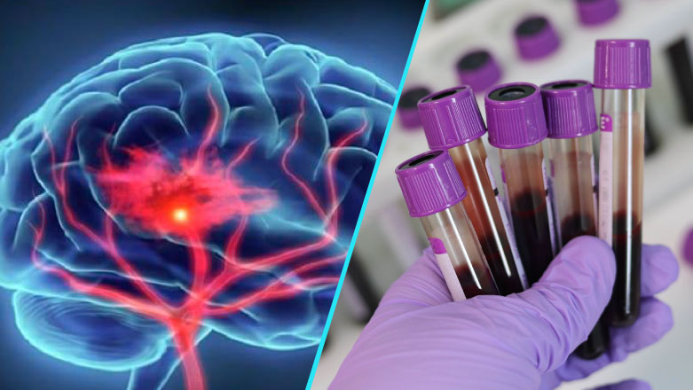 A fost lansat un test de sange care ar putea ajuta la diagnosticarea maladiei Alzheimer
