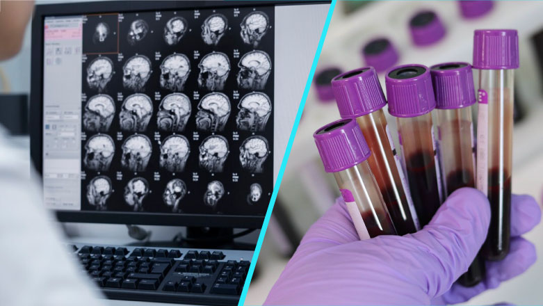Studiu: Primul test in flux lateral din lume pentru detectarea tumorilor cerebrale