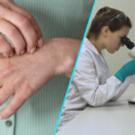 Actualizare in tratamentul dermatitei atopice: Patru terapii noi validate de specialistii americani