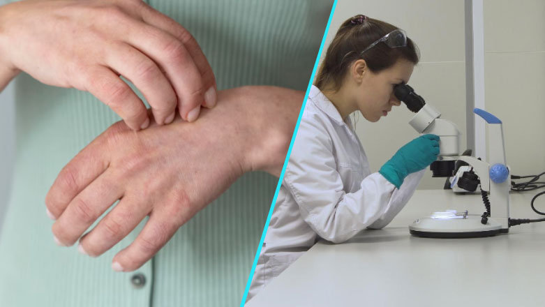 Actualizare in tratamentul dermatitei atopice: Patru terapii noi validate de specialistii americani