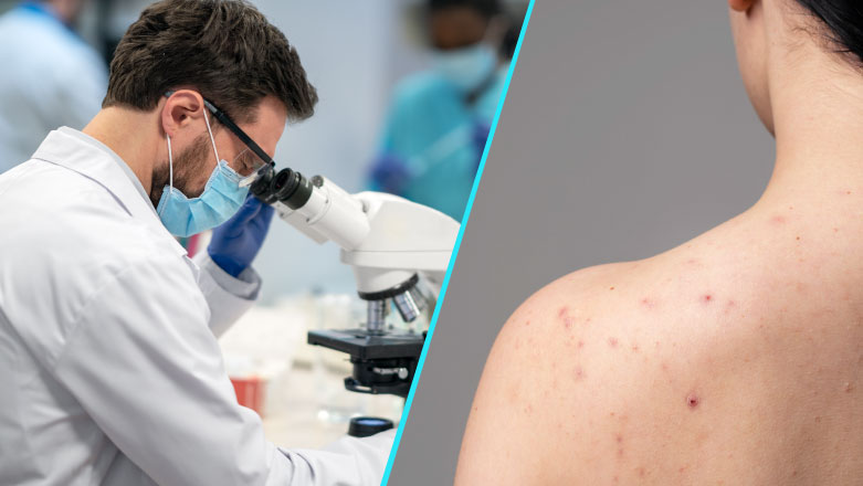 Descoperire surprinzatoare: Un virus aparent banal poate declansa cancerul de piele