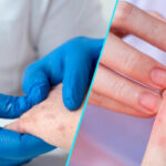 Dermatita atopica – mai mult decat o iritatie a pielii | O lupta cu efecte zilnice asupra vietii