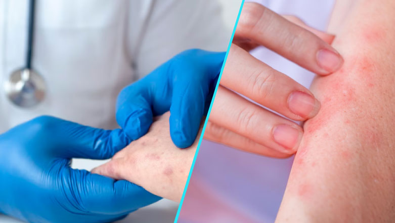 Dermatita atopica – mai mult decat o iritatie a pielii | O lupta cu efecte zilnice asupra vietii