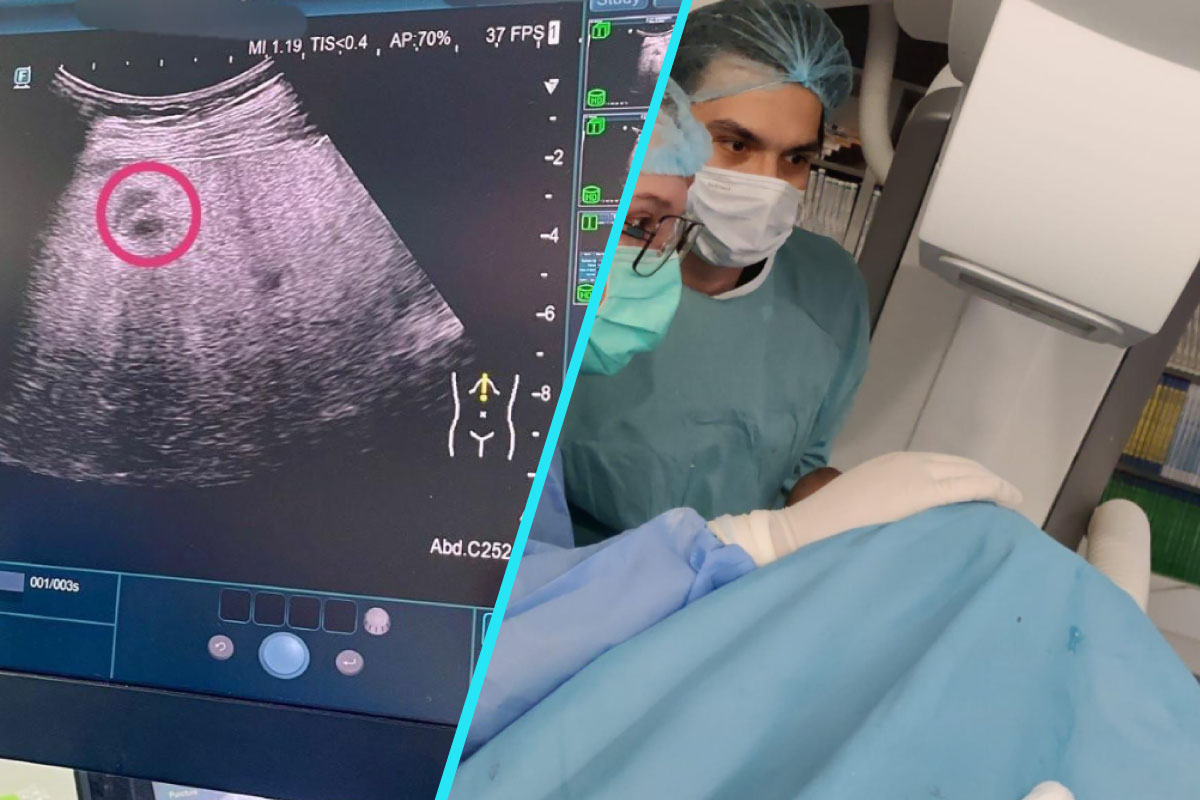Premiera medicala la SUUB | Ablatie hepatica sub ghidaj Cone-Beam CT