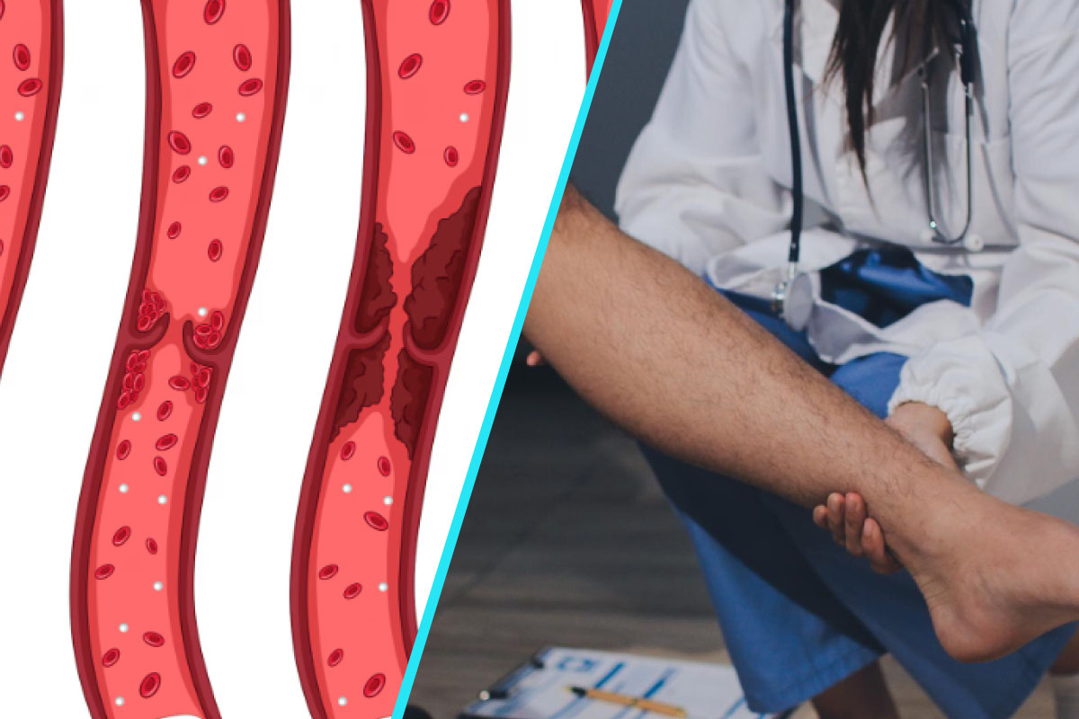 Ce este trombofilia si de ce poate deveni periculoasa