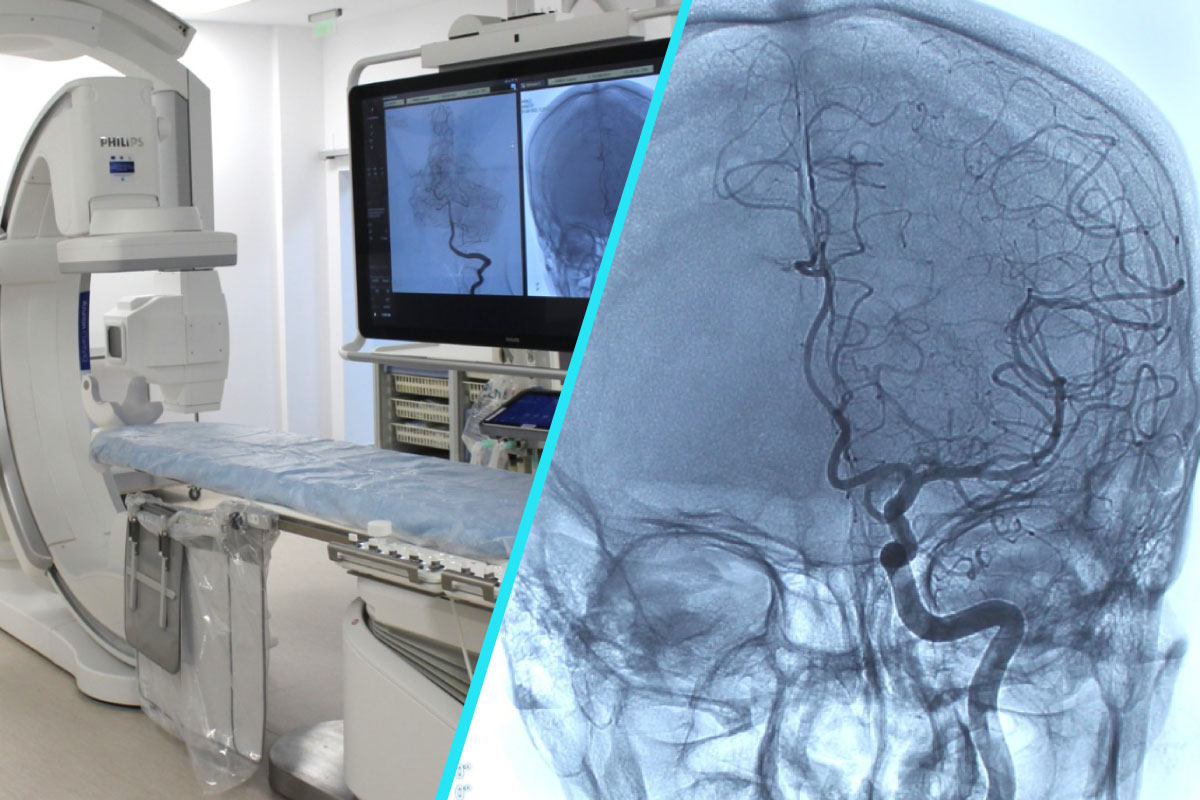 Tehnologie de top pentru tratamentul AVC | Spitalul Judetean Sibiu, centru de referinta