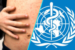 Criza rujeolei atinge niveluri alarmante in Europa