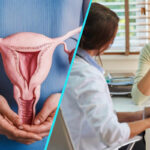 Cancerul ovarian, descoperit prea tarziu in 3 din 4 cazuri | Ghid pentru recunoasterea simptomelor