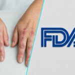 FDA a aprobat primul medicament oral pentru tratarea dermatomiozitei la adulti