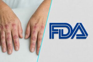 FDA a aprobat primul medicament oral pentru tratarea dermatomiozitei la adulti