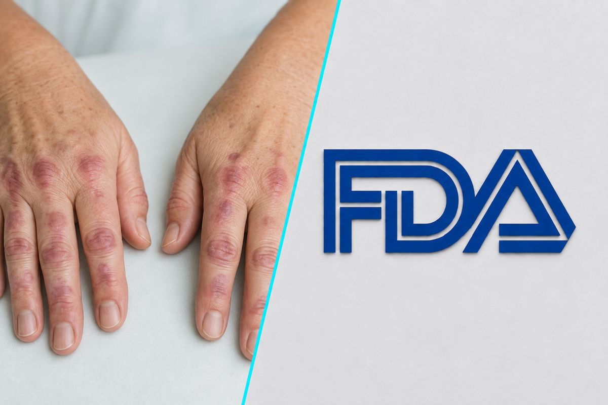 FDA a aprobat primul medicament oral pentru tratarea dermatomiozitei la adulti