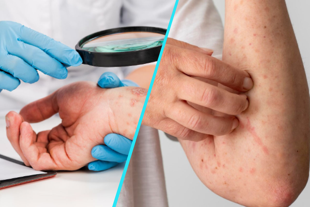 Dermatita atopica | Campanie de informare pentru pacienti si apartinatori