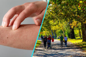 Dermatita atopica, mai mult decat “o iritatie a pielii” | Povara nevazuta a bolii
