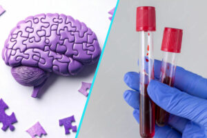 Un test de sange si o analiza genetica pot anticipa aparitia simptomelor bolii Alzheimer cu pana la sase ani