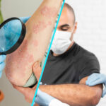 Psoriazisul afecteaza mai mult decat pielea | 400.000 de romani traiesc cu boala
