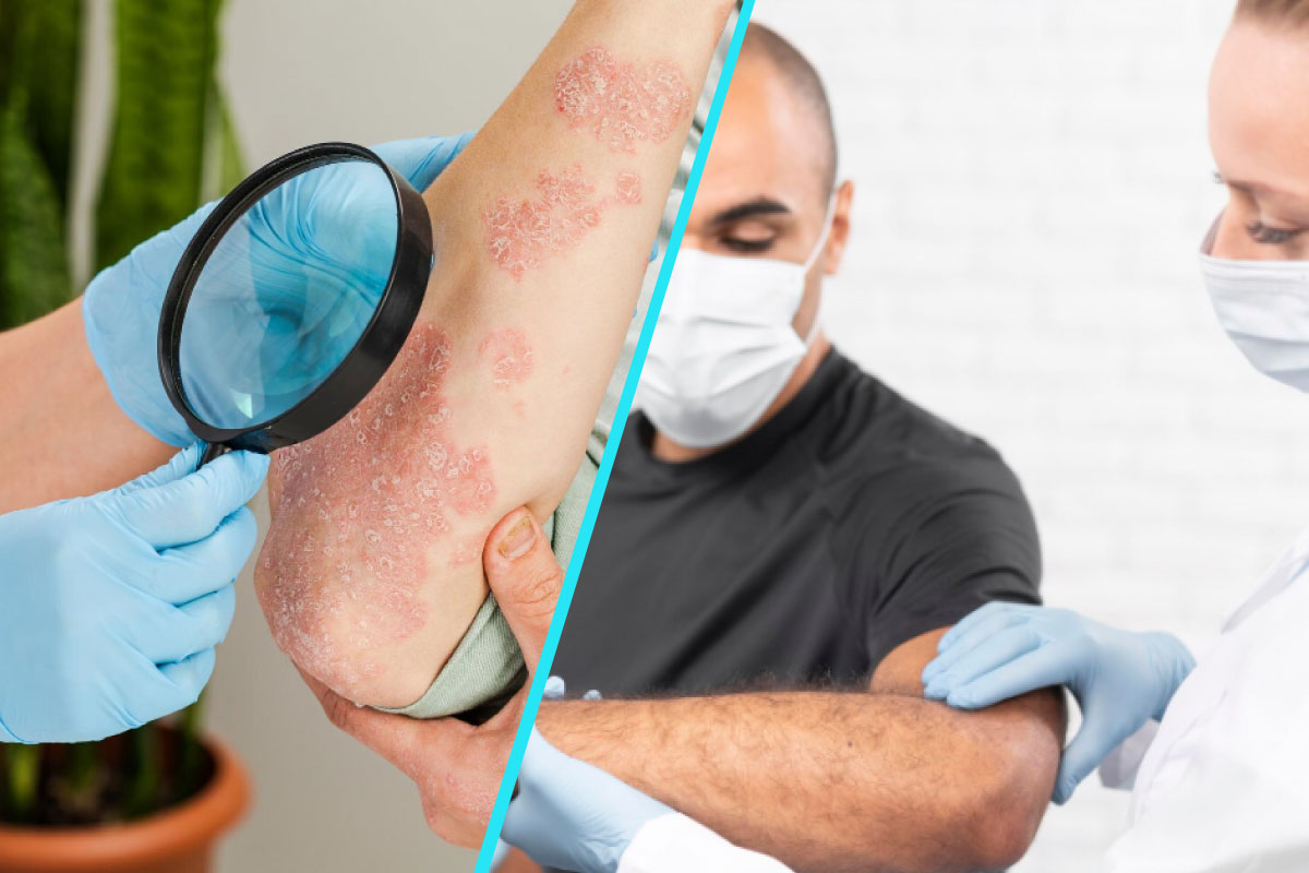 Psoriazisul afecteaza mai mult decat pielea | 400.000 de romani traiesc cu boala