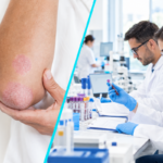 Un tratament oral experimental pentru psoriazis arata rezultate favorabile la o mare parte dintre pacienti