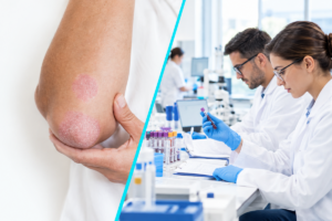 Un tratament oral experimental pentru psoriazis arata rezultate favorabile la o mare parte dintre pacienti