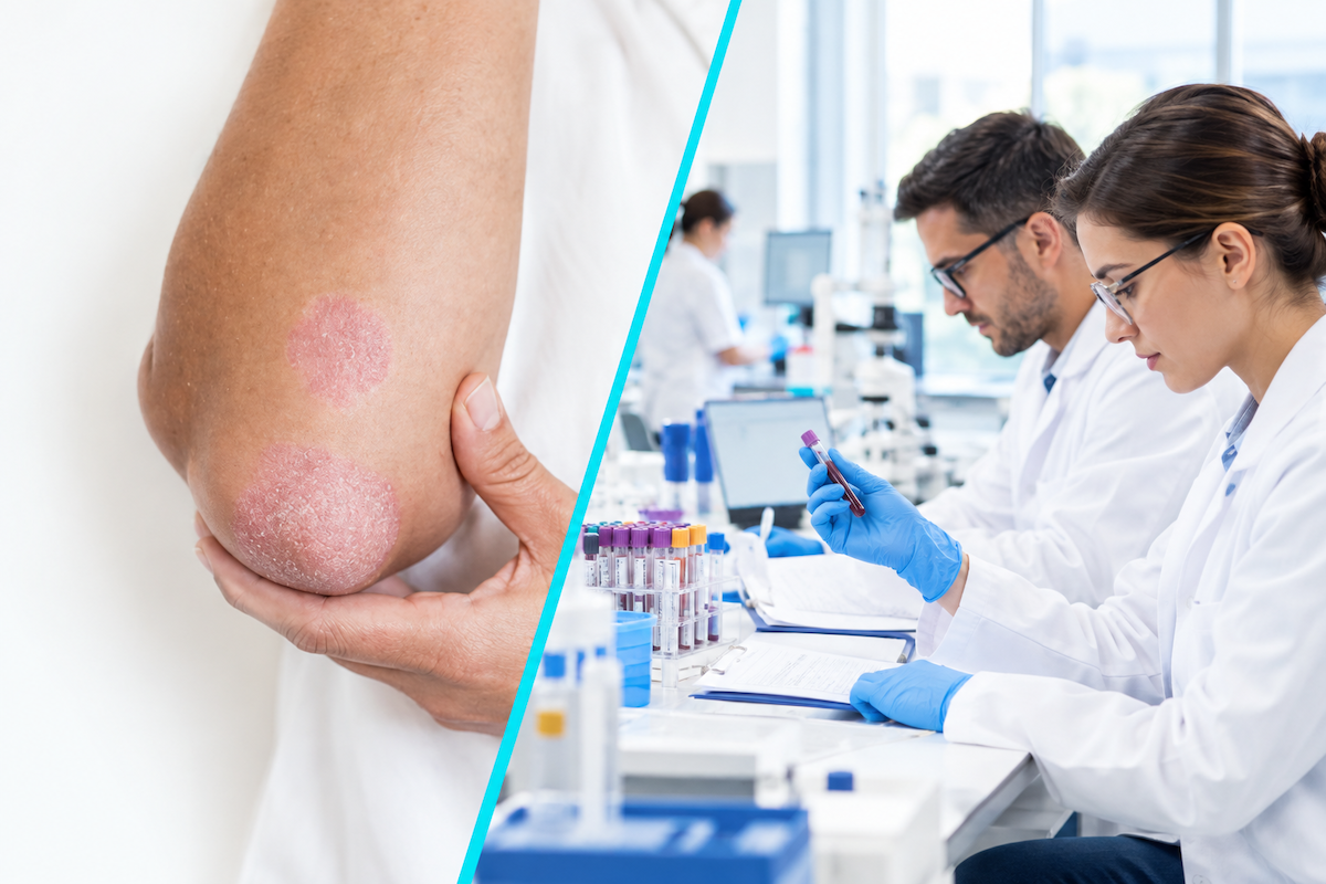 Un tratament oral experimental pentru psoriazis arata rezultate favorabile la o mare parte dintre pacienti